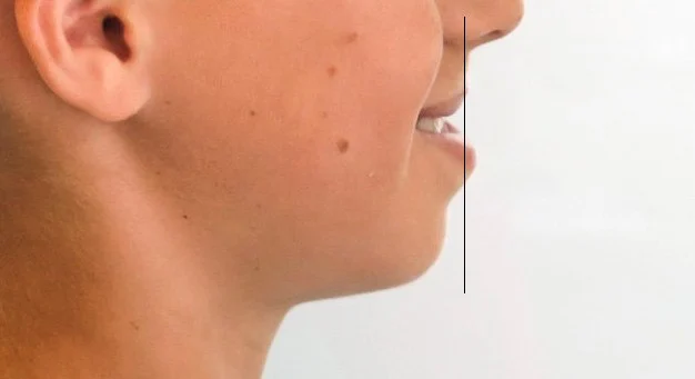 Înainte de tratament: Profilul facial: treapta labială inversată