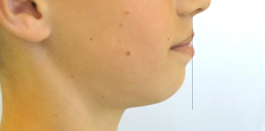 După tratament: Profilul facial: treapta labială inversată