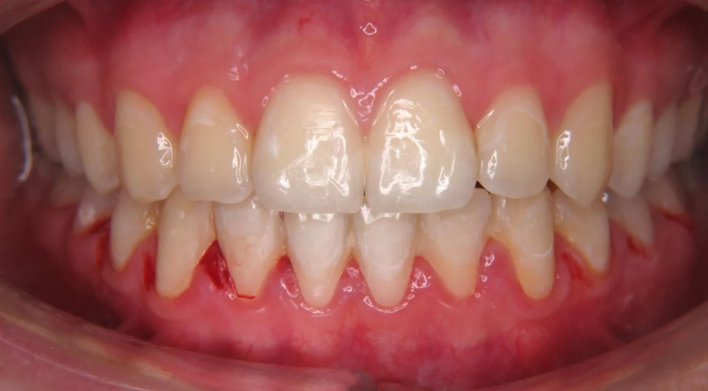 Canin superior ectopic, aliniat cu aparat metalic la 15 ani